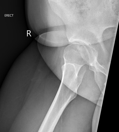 Acetabular dysplasia with secondary osteoarthritis | Image ...