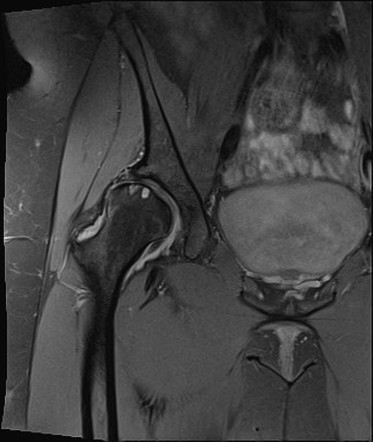 Acetabular Dysplasia Radiology Reference Article Radiopaedia Org