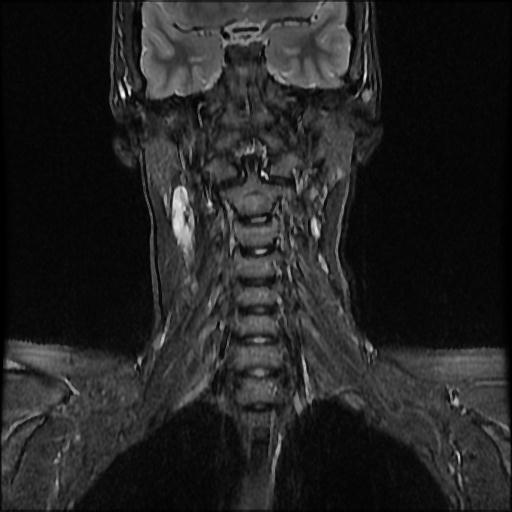 Second Branchial Cleft Cyst Image 2584