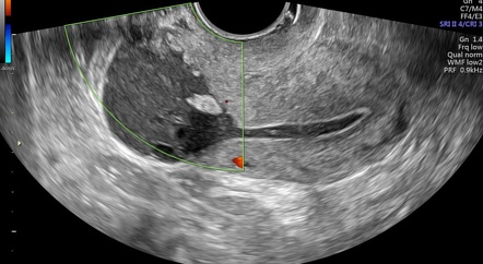 Cesarean scar niche with blood collection | Image | Radiopaedia.org