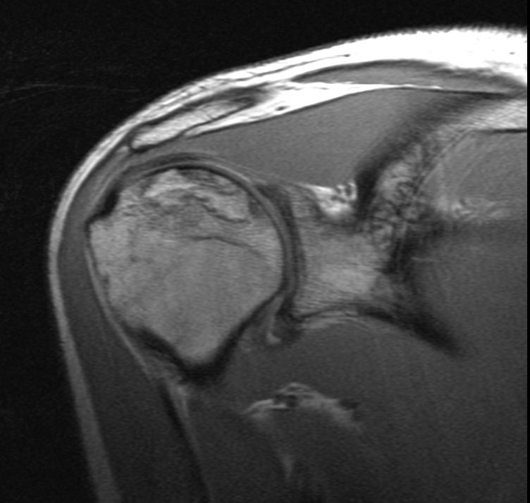 Асептический некроз. Асептический некроз плечевой кости мрт. Асептический некроз головки плечевой кости мрт. Аваскулярный некроз плечевой кости. Асептический некроз головки мрт.