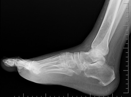 Plantar calcaneal spur | Radiology Reference Article | Radiopaedia.org