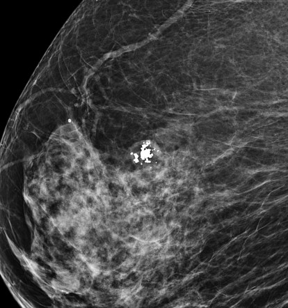 Popcorn calcification - breast | Radiology Case | Radiopaedia.org