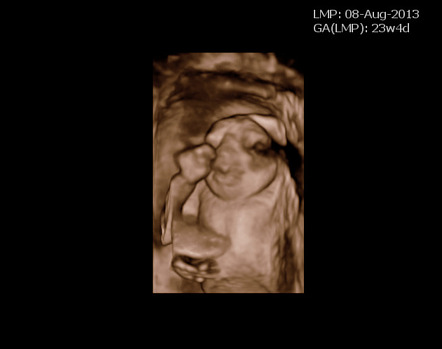 Acrania anencephaly sequence | Radiology Reference Article ...