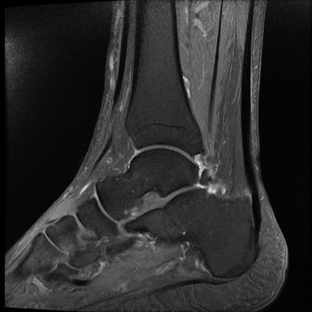 Tarsal tunnel syndrome | Image | Radiopaedia.org