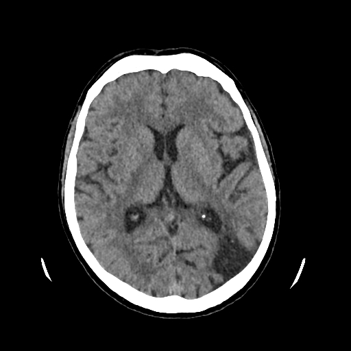 Old watershed infarct and incidental silent sinus syndrome | Image ...