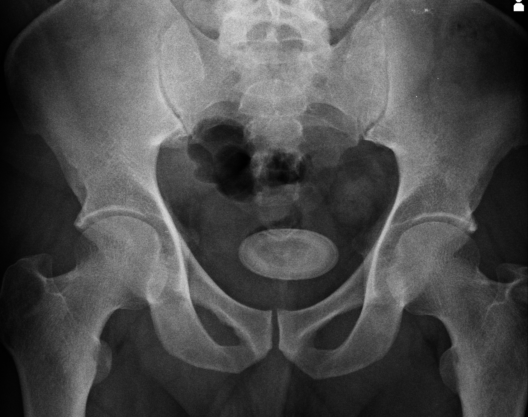 Bladder Calculus | Image | Radiopaedia.org