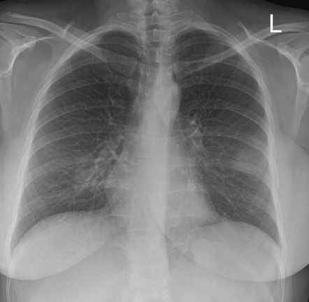 Bilateral bronchopneumonia | Radiology Case | Radiopaedia.org