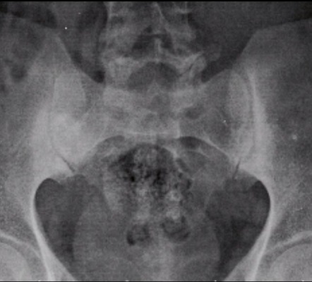 Osteitis condensans ilii - in a male patient | Image | Radiopaedia.org