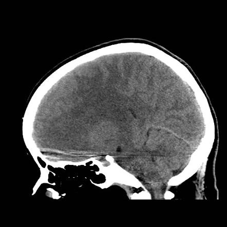 Subacute subdural hematoma | Image | Radiopaedia.org