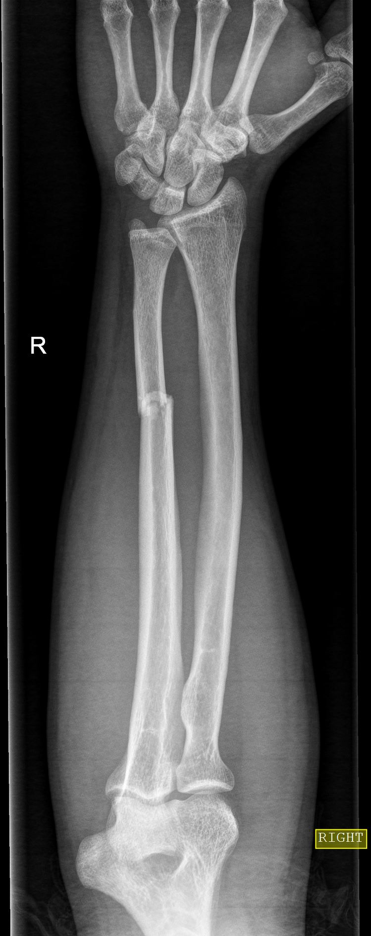 Isolated ulna shaft fracture | Image | Radiopaedia.org