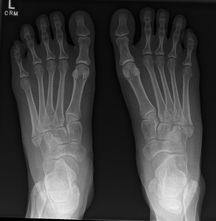 Avulsion fracture of the 5th metatarsal styloid | Radiology Reference ...