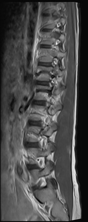 EBV-associated smooth muscle tumor | Image | Radiopaedia.org