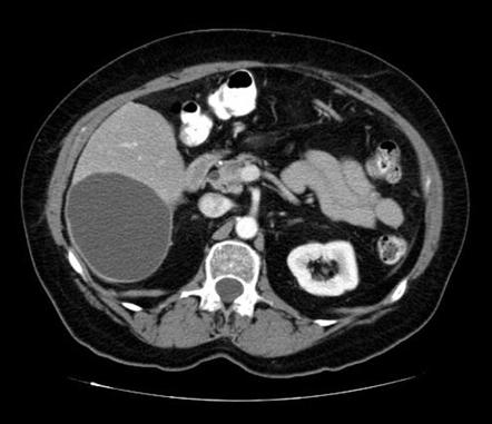 Biliary cystadenoma | Radiology Reference Article | Radiopaedia.org