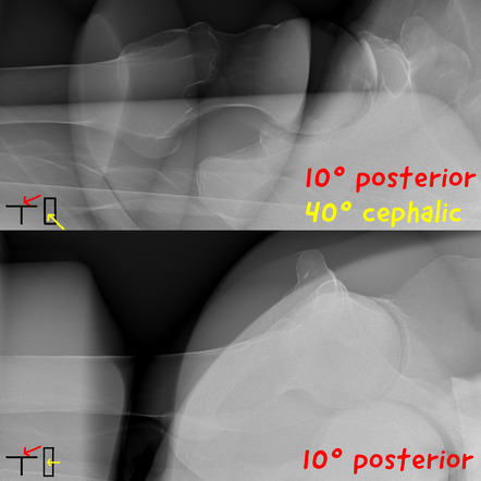 Hip (Clements-Nakayama view) | Radiology Reference Article ...