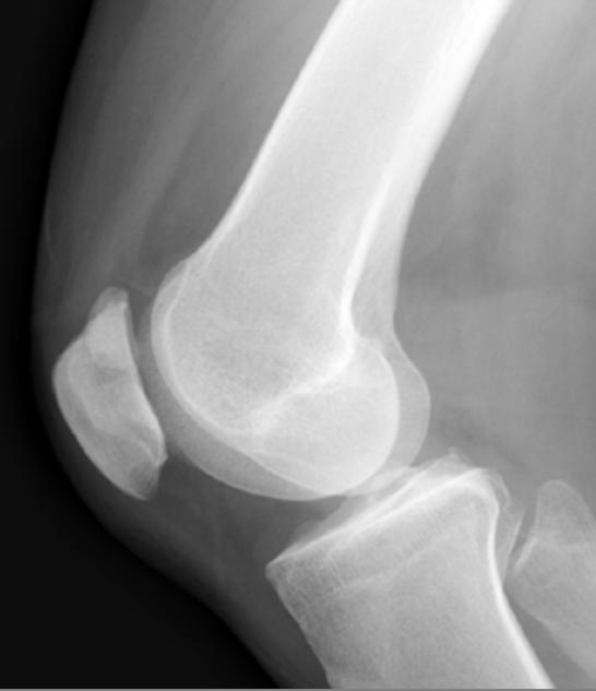 Bipartite Patella Image