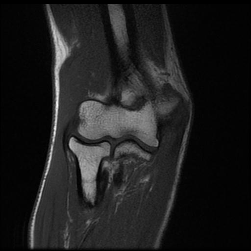 Medial epicondylitis | Image | Radiopaedia.org