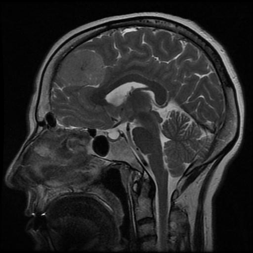 Falx meningioma | Image | Radiopaedia.org