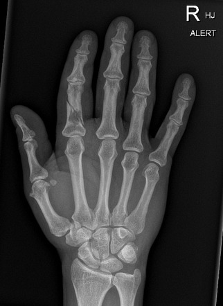 Enchondroma with pathological fracture and incidental exostosis ...