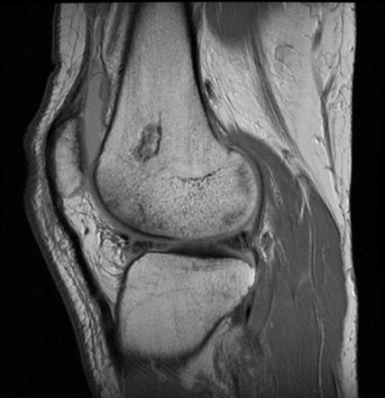 Bone infarct | Radiology Case | Radiopaedia.org