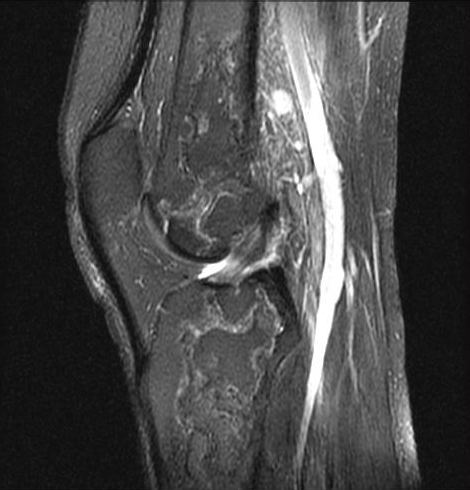 Bone infarct | Image | Radiopaedia.org