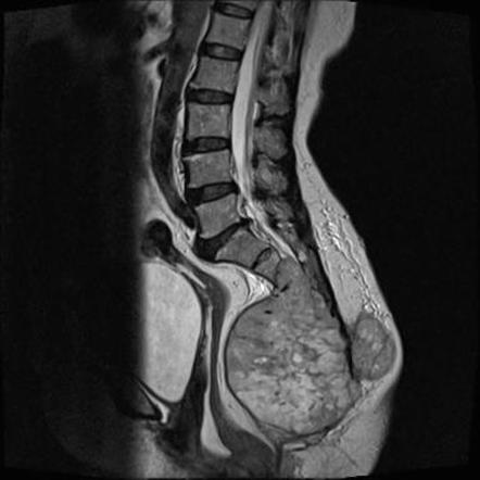 Sacral chordoma | Image | Radiopaedia.org