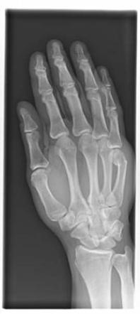 Boxer fracture | Image | Radiopaedia.org