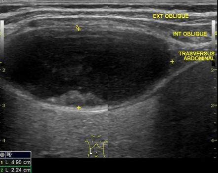 Tuberculous abscess - anterior abdominal wall | Radiology Case ...