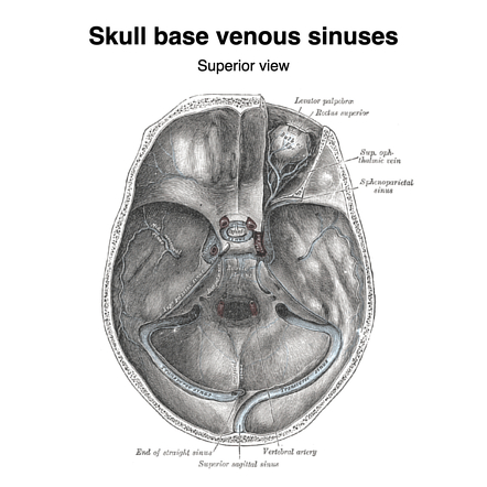 Sigmoid sinus | Radiology Reference Article | Radiopaedia.org