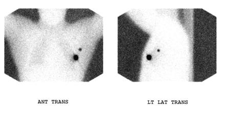 Lymphoscintigraphy | Radiology Reference Article | Radiopaedia.org