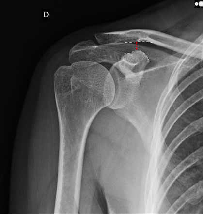 Lateral triangular space  Radiology Reference Article