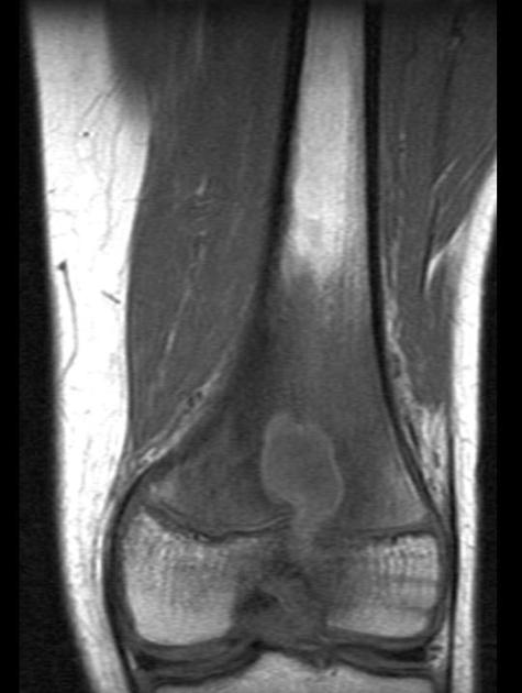 Brodie abscess | Radiology Case | Radiopaedia.org