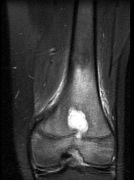 Brodie abscess Radiology Reference Article Radiopaedia