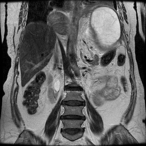 Subphrenic hydatid cyst at upper surface of spleen | Image ...