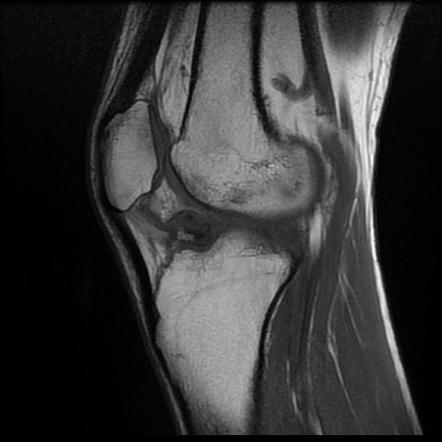 Anterior Cruciate Ligament Avulsion Fracture 