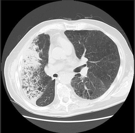 Adenocarcinoma in situ, minimally invasive adenocarcinoma and invasive