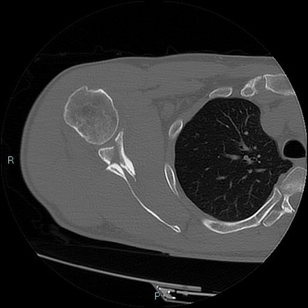 Ideberg Classification Of Glenoid Fossa Fractures 