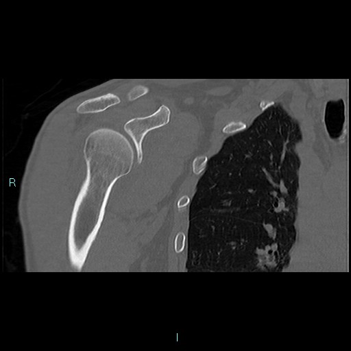 Scapular Fracture Ideberg Type Ii Image