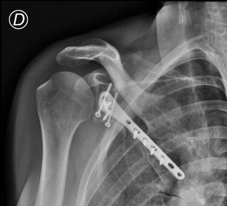 Scapular fracture - Ideberg type II | Image | Radiopaedia.org