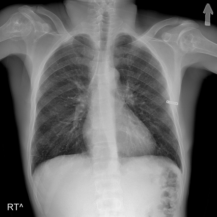 Osteonecrosis | Radiology Reference Article | Radiopaedia.org