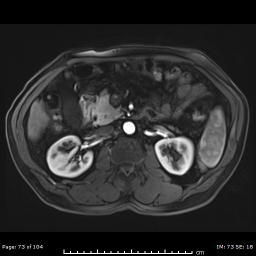 LI-RADS 5 lesion | Image | Radiopaedia.org