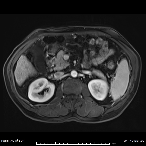 Li-rads 5 Lesion 