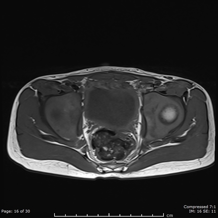 Infected urachal cyst with urachal-sigmoid fistula | Radiology Case ...