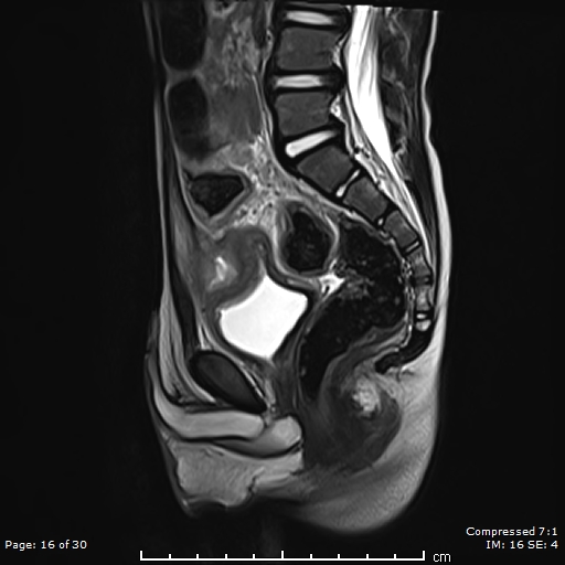 Infected urachal cyst with urachal-sigmoid fistula | Image ...