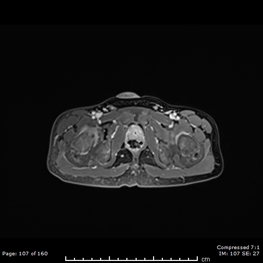 Infected urachal cyst with urachal-sigmoid fistula | Image ...