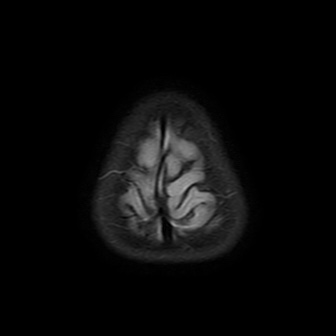 Pyruvate dehydrogenase deficiency | Image | Radiopaedia.org