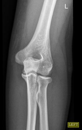 Radial head fracture | Radiology Case | Radiopaedia.org