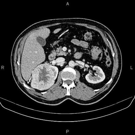 Renal oncocytoma | Radiology Case | Radiopaedia.org