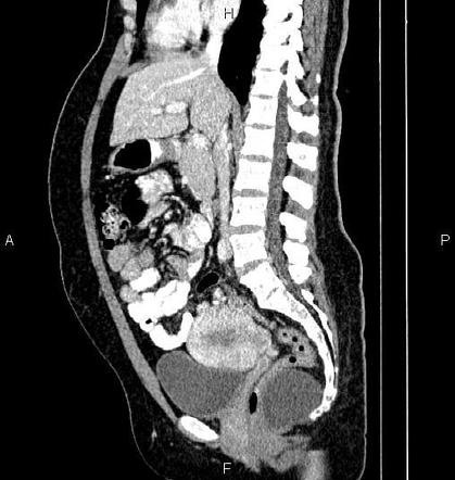 Tailgut cyst | Radiology Reference Article | Radiopaedia.org