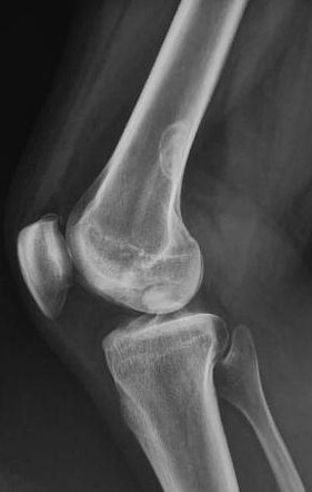 Osteochondritis dissecans of the knee | Image | Radiopaedia.org